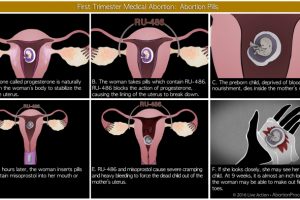 Medical-abortion-diagram